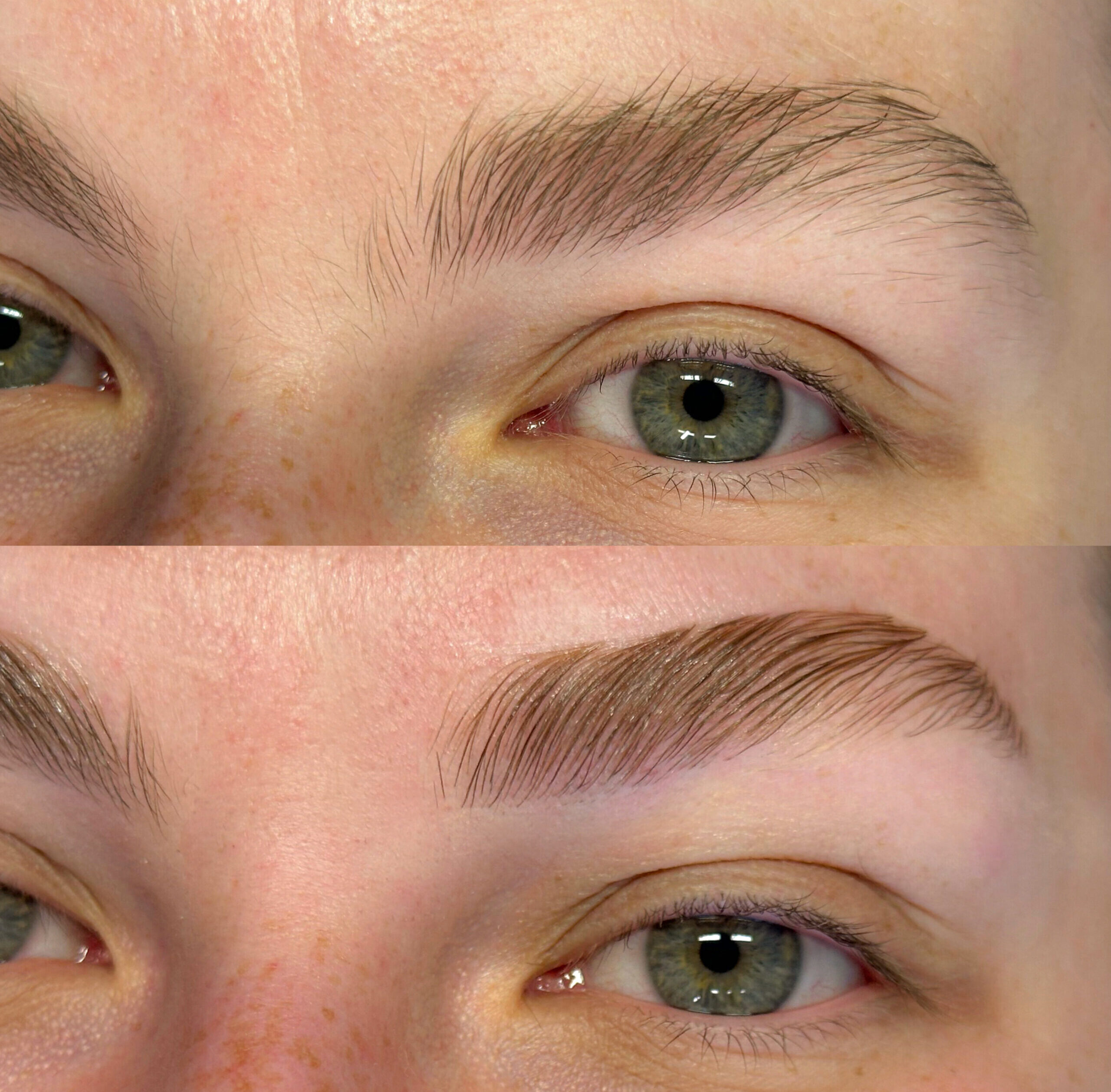 Antes e depois Brow lifting 2
