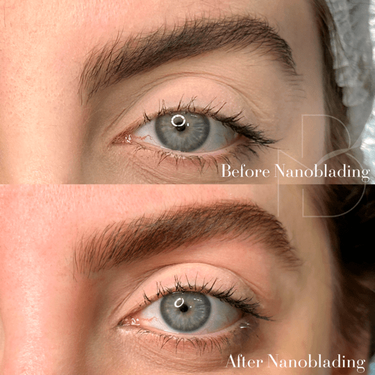 antes-e-depois-Nanoblading-005.jpeg-min.png