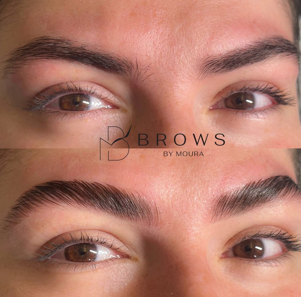 BROW LIFTING - Before and After-min