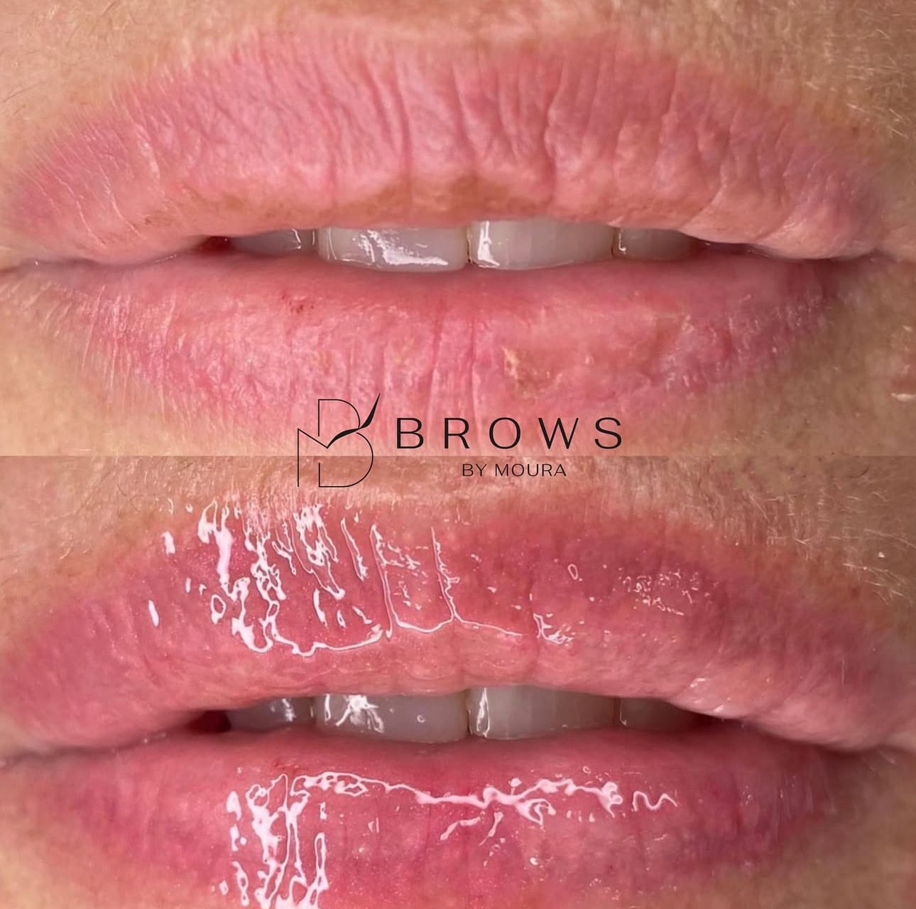 Before-After-Revita-Lips (1)-min