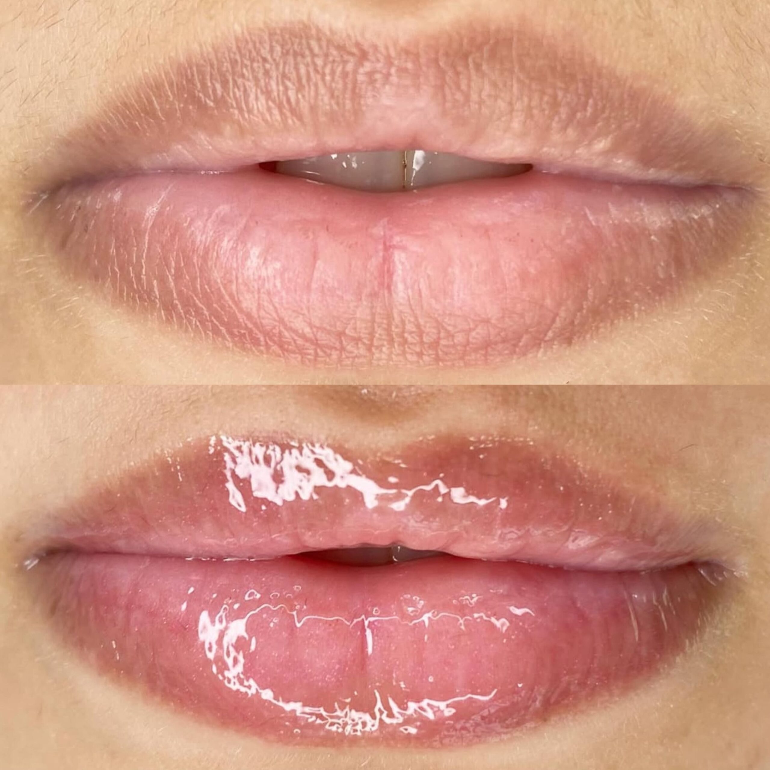 Before-After-Revita-Lips (1)-min