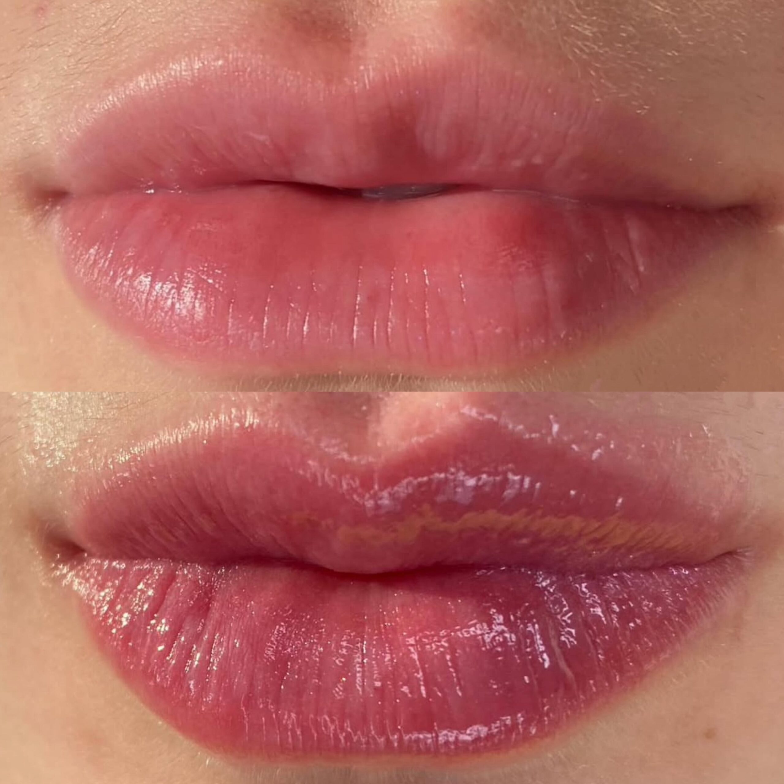 Before-After-Revita-Lips (2)-min