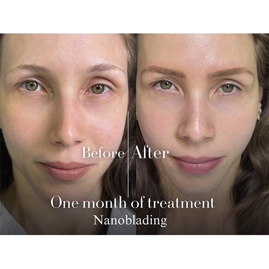 antes-e-depois-Nanoblading-0010-min