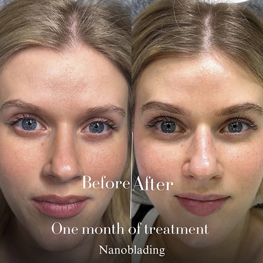 antes-e-depois-Nanoblading-0013-min